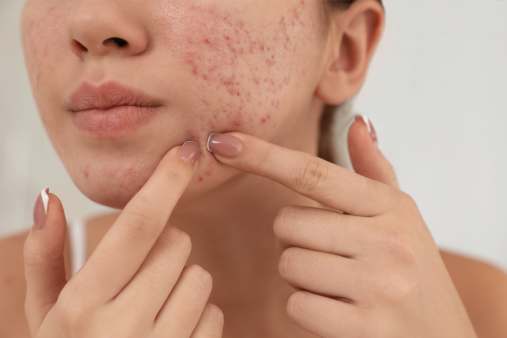 Acne Mark Treatment skin haven clinic dr. sampriti book appointment3