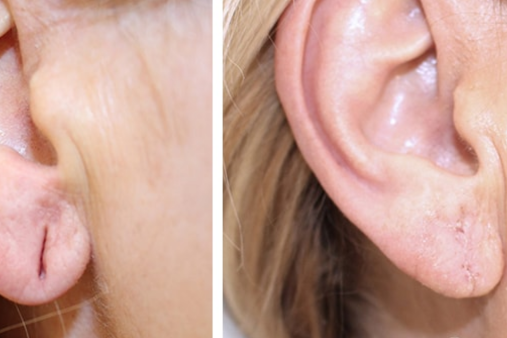 Earlobe repair skin haven clinic dr. sampriti book appointment