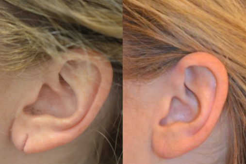 Earlobe repair skin haven clinic dr. sampriti book appointment