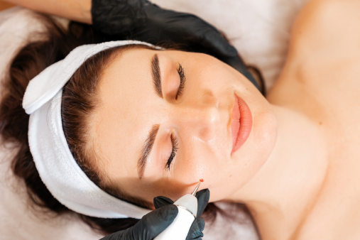 Laser Mole Removal skin haven clinic dr. sampriti book appointment