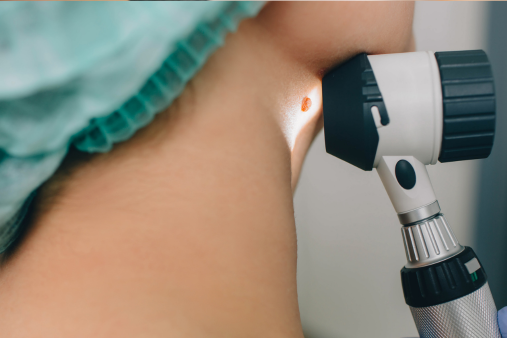Laser Mole Removal skin haven clinic dr. sampriti book appointment