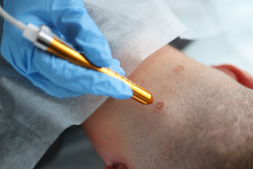 Laser Mole Removal skin haven clinic dr. sampriti book appointment
