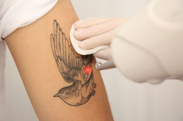 Skin Haven Dr. Sampriti tattoo Removal